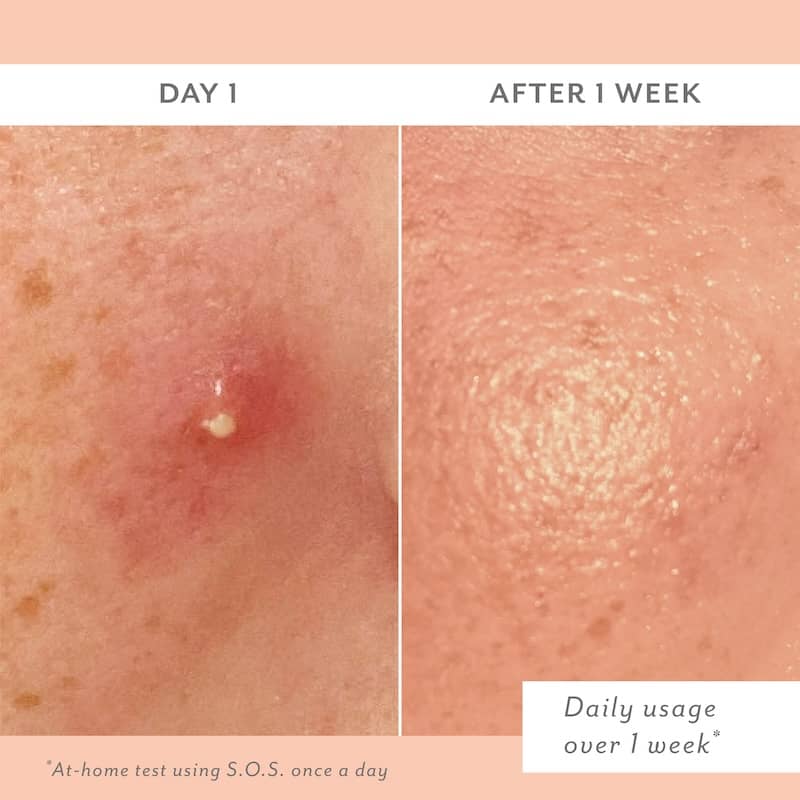 S.O.S Clarifying Liquid Patch